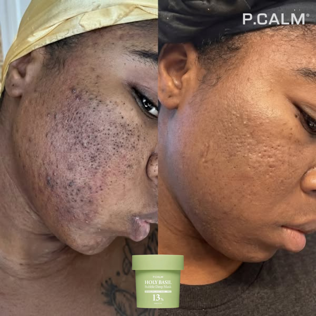 HOLY BASIL - Obtenez un visage propre et sans imperfections en 7 jours